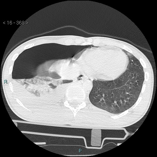 Blunt chest trauma (Swiss cheese sign) (Radiopaedia 38519-40618 Axial lung window 65).jpg