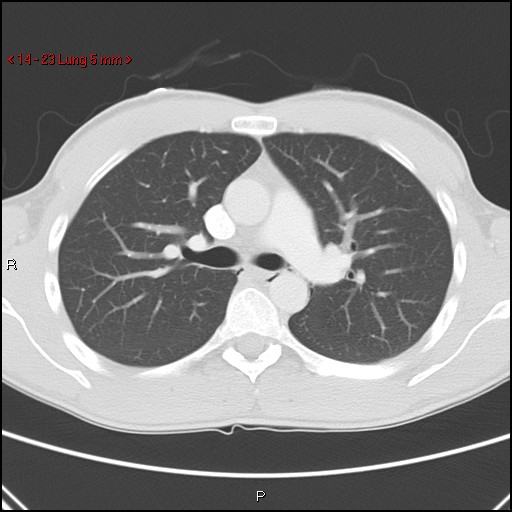 Blunt chest trauma - pulmonary interstitial emphysema and pneumomediastinum (Radiopaedia 20666-20552 Axial lung window 23).jpg