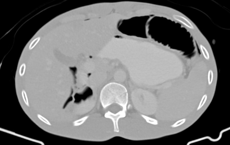 Blunt injury to the small bowel (Radiopaedia 74953-85987 Axial Wide 16).jpg