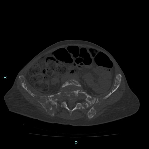 Bone metastases from untreated breast cancer (Radiopaedia 42973-46219 Axial bone window 144).jpg