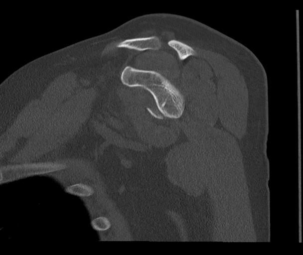 Bony Bankart and Hill-Sachs lesions (Radiopaedia 33622-34727 Sagittal bone window 33).png