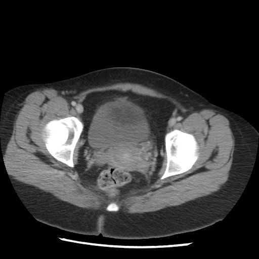 File:Borderline mucinous tumor (ovary) (Radiopaedia 78228-90808 A 132).jpg