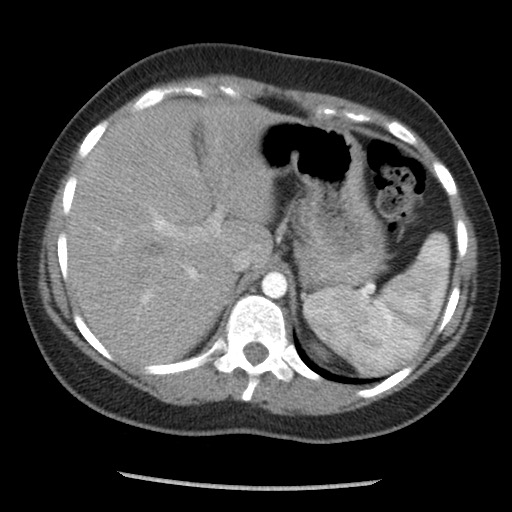 File:Borderline mucinous tumor (ovary) (Radiopaedia 78228-90808 A 43).jpg