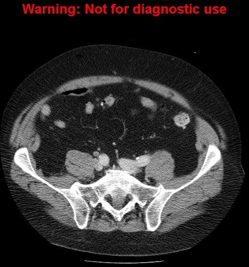 File:Bosniak renal cyst - type IV (Radiopaedia 23402-23466 D 57).jpg