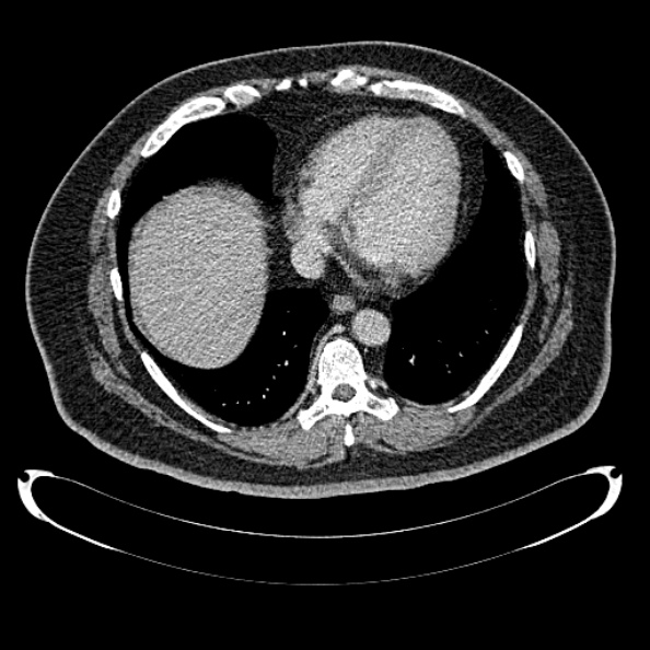 Bosniak renal cyst - type IV (Radiopaedia 24244-24518 C 5).jpg