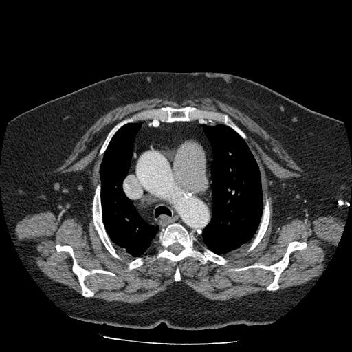 Bovine aortic arch - right internal mammary vein drains into the superior vena cava (Radiopaedia 63296-71875 A 42).jpg