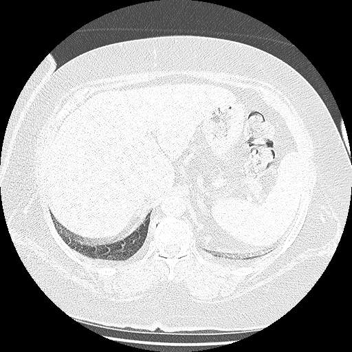 Bovine aortic arch - right internal mammary vein drains into the superior vena cava (Radiopaedia 63296-71875 Axial lung window 169).jpg