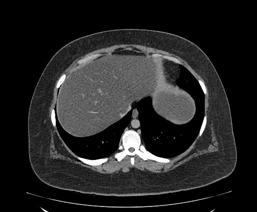 Bowel and splenic infarcts in acute lymphocytic leukemia (Radiopaedia 61055-68913 A 21).jpg