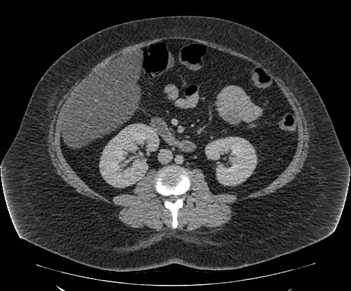 Bowel and splenic infarcts in acute lymphocytic leukemia (Radiopaedia 61055-68913 A 66).jpg