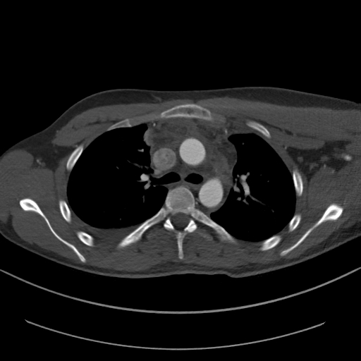 Brachiocephalic trunk pseudoaneurysm (Radiopaedia 70978-81191 Axial bone window 69).jpg