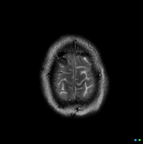 File:Brain death on MRI and CT angiography (Radiopaedia 42560-45689 Axial T2 29).jpg