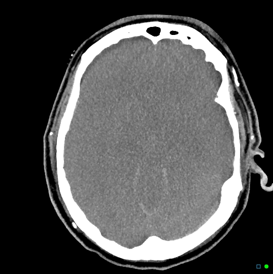 Brain death on MRI and CT angiography (Radiopaedia 42560-45841 B 30).jpg