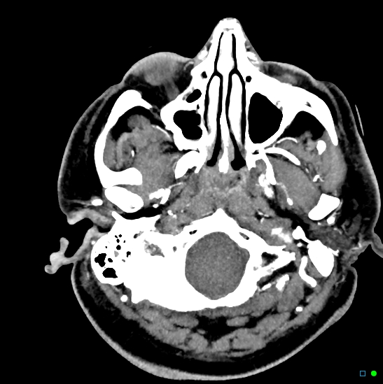 Brain death on MRI and CT angiography (Radiopaedia 42560-45841 B 46).jpg