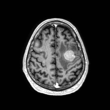 Brain metastases from lung cancer (Radiopaedia 83839-99028 Axial T1 C+ 53).jpg
