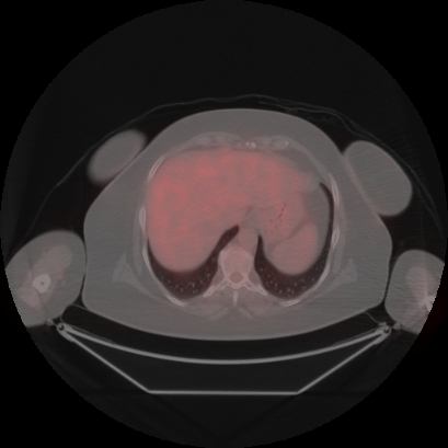 Brain metastasis (Radiopaedia 89847-106962 Axial lung window 53).jpg