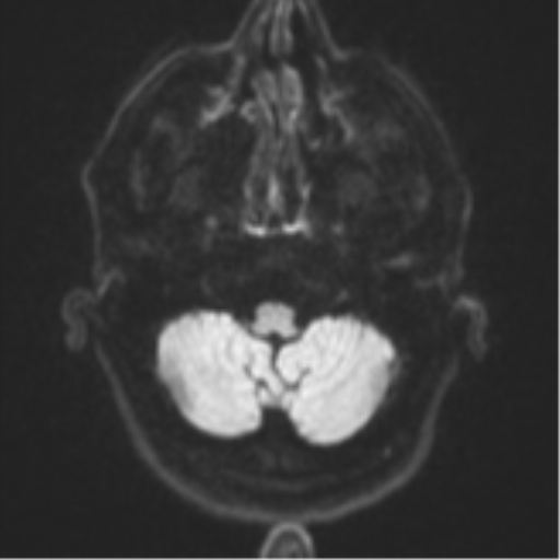 Brain metastasis (large cystic mass) (Radiopaedia 47497-52107 Axial DWI 32).png