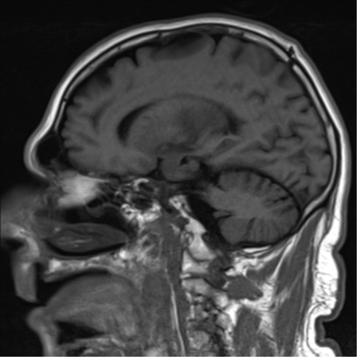File:Brain metastasis (large cystic mass) (Radiopaedia 47497-52107 Sagittal T1 12).png