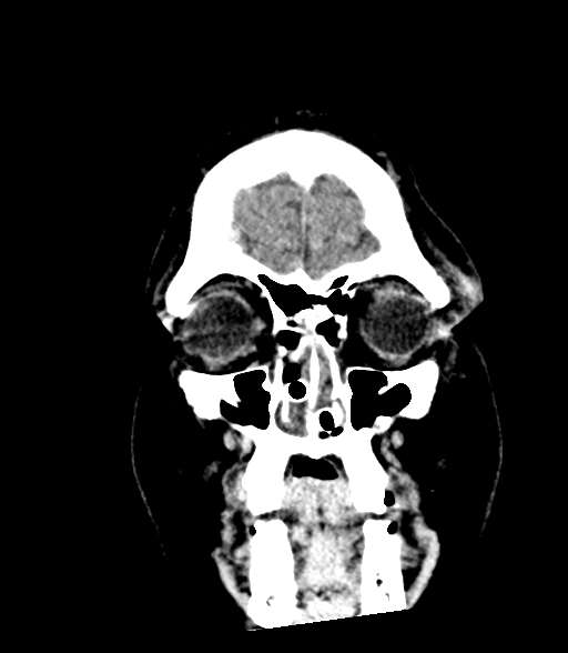 Brainstem hemorrhage (Radiopaedia 81294-94976 Coronal non-contrast 8).jpg