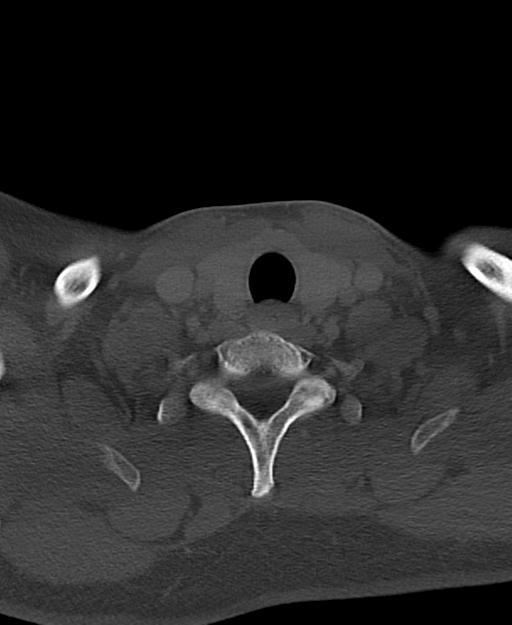Branchial cleft cyst (Radiopaedia 31167-31875 Axial bone window 61).jpg