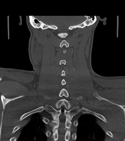 Branchial cleft cyst (Radiopaedia 31167-31875 Coronal bone window 49).jpg