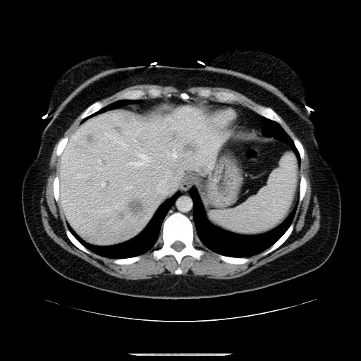 File:Breast cancer pseudocirrhosis after chemotherapy (Radiopaedia 65407-74456 A 16).jpg
