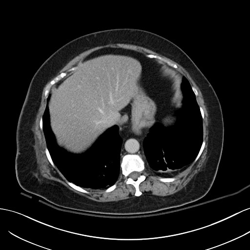 Breast carcinoma with pathological hip fracture (Radiopaedia 60314-67974 B 10).jpg