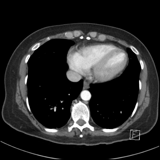 File:Breast metastases from renal cell cancer (Radiopaedia 79220-92225 A 69).jpg