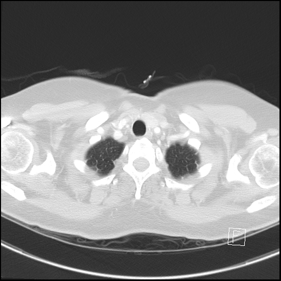 File:Breast metastases from renal cell cancer (Radiopaedia 79220-92225 Axial lung window 5).jpg