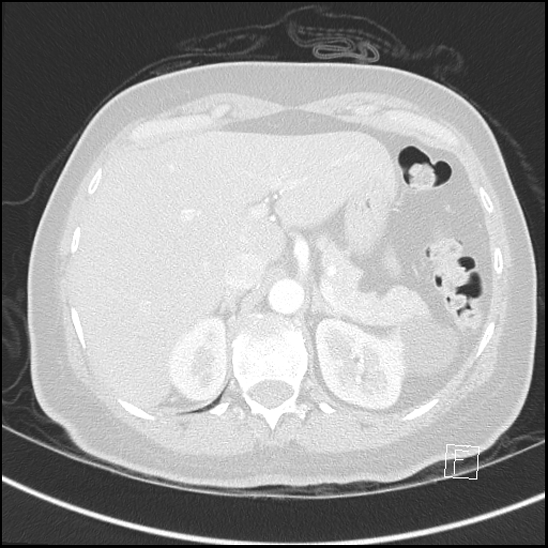 File:Breast metastases from renal cell cancer (Radiopaedia 79220-92225 Axial lung window 84).jpg