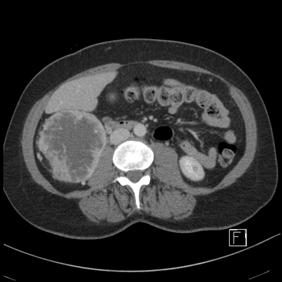 File:Breast metastases from renal cell cancer (Radiopaedia 79220-92225 C 52).jpg
