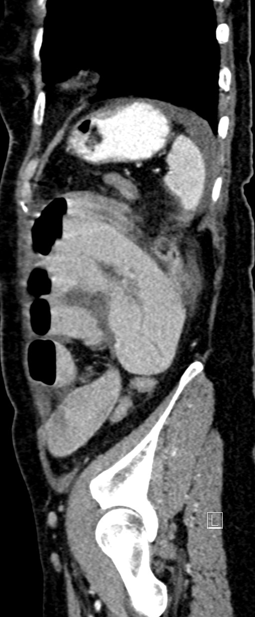 Broad ligament hernia (Radiopaedia 84802-100276 C 10).jpg