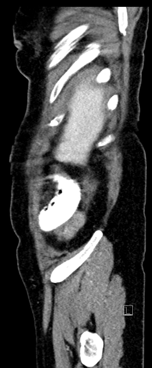 Broad ligament hernia (Radiopaedia 84802-100276 C 77).jpg