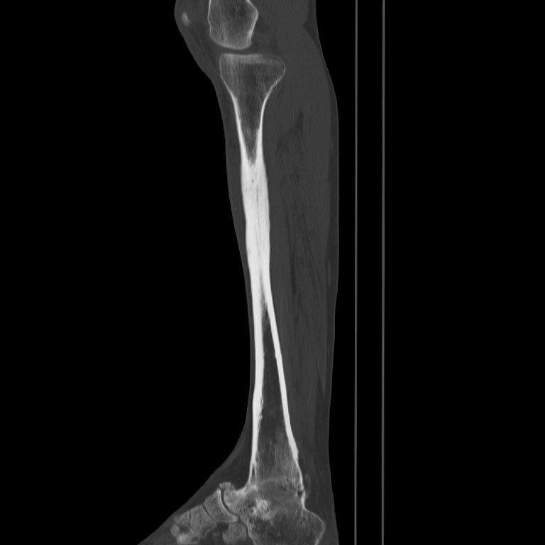 Brodie abscess - tibia (Radiopaedia 66028-75204 Sagittal bone window 23).jpg