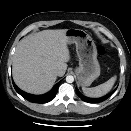 Bronchial carcinoid tumor (Radiopaedia 67377-76764 A 55).jpg