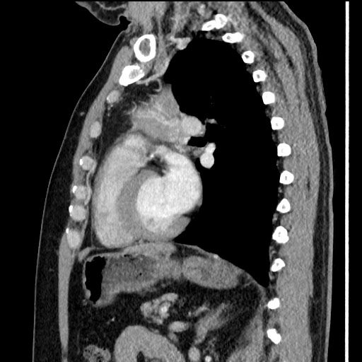 Bronchial carcinoid tumor (Radiopaedia 67377-76764 E 43).jpg