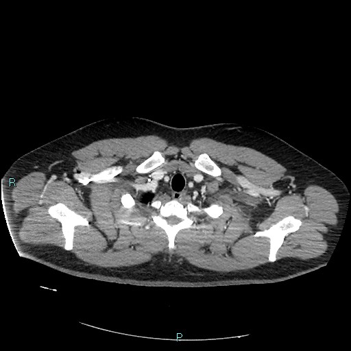 File:Bronchial carcinoid tumor (Radiopaedia 78272-90875 A 16).jpg