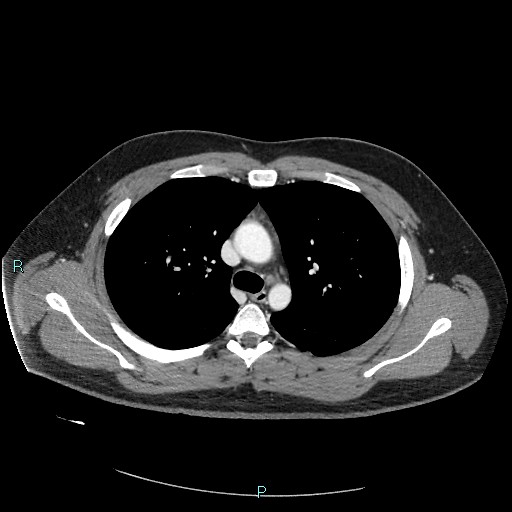 Bronchial carcinoid tumor (Radiopaedia 78272-90875 A 38).jpg