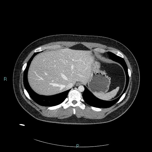 Bronchial carcinoid tumor (Radiopaedia 78272-90875 A 83).jpg