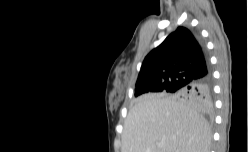 Bronchial mucoepidermoid carcinoma (Radiopaedia 57023-63895 Sagittal 39).jpg