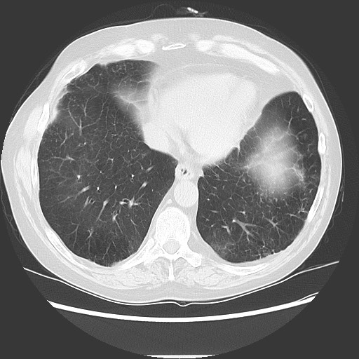 Bronchial stenosis - lung transplant (Radiopaedia 73133-83848 Axial lung window 47).jpg