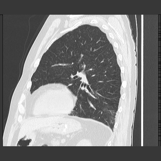 Bronchial stenosis - lung transplant (Radiopaedia 73133-83848 Sagittal lung window 48).jpg