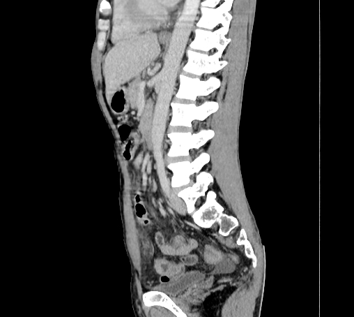 File:Bronchiectasis in Crohn disease (Radiopaedia 60311-67977 D 65).jpg