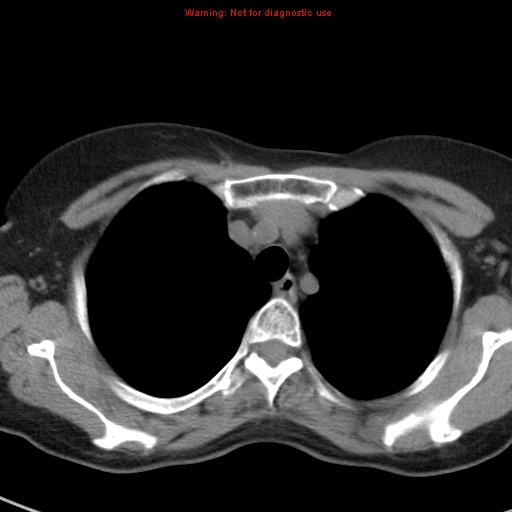 File:Bronchoalveolar carcinoma (BAC) (Radiopaedia 13436-13392 Axial non-contrast 11).jpg