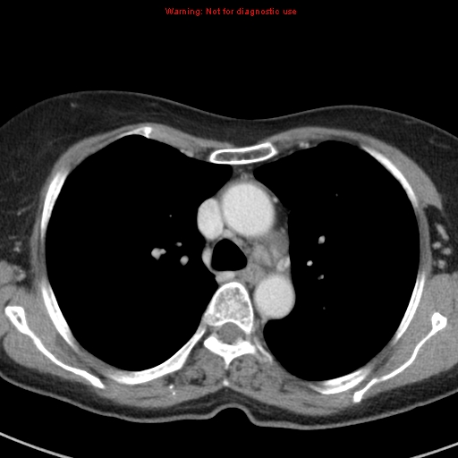 File:Bronchoalveolar carcinoma (BAC) (Radiopaedia 13436-13392 B 19).jpg