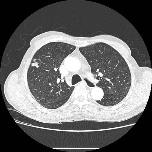 Bronchocele (Radiopaedia 17097-16795 Axial lung window 44).jpg
