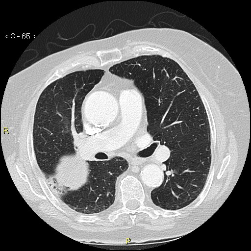 File:Bronchogenic carcinoma as an incidental finding (Radiopaedia 16453-16130 Axial lung window 65).jpg