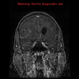 File:Bronchogenic carcinoma brain metastasis (Radiopaedia 9286-9969 Coronal T1 29).jpg