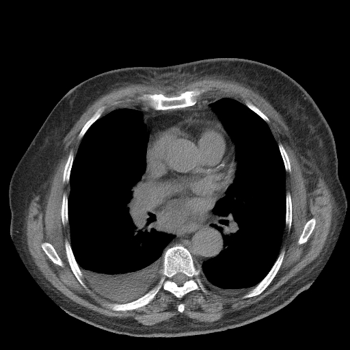 Bronchogenic carcinoma with metastatic lymphadenopathy (Radiopaedia 37671-39569 Axial non-contrast 30).jpg
