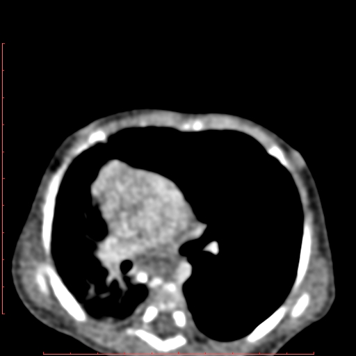 Bronchogenic cyst (Radiopaedia 78599-91409 B 101).jpg