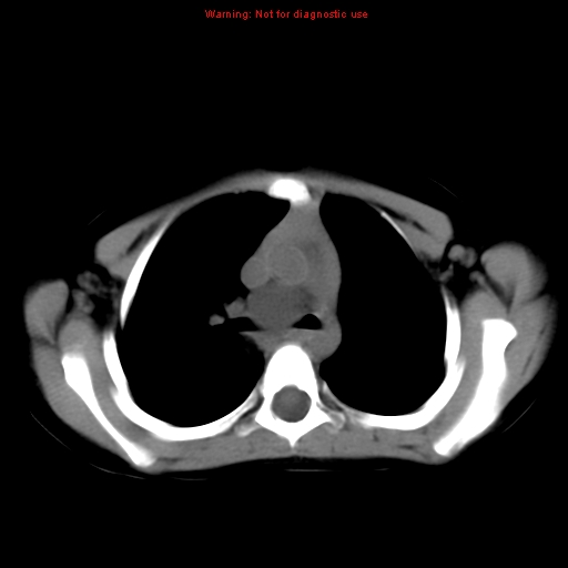 File:Bronchogenic cyst (Radiopaedia 9372-10063 Axial non-contrast 7).jpg